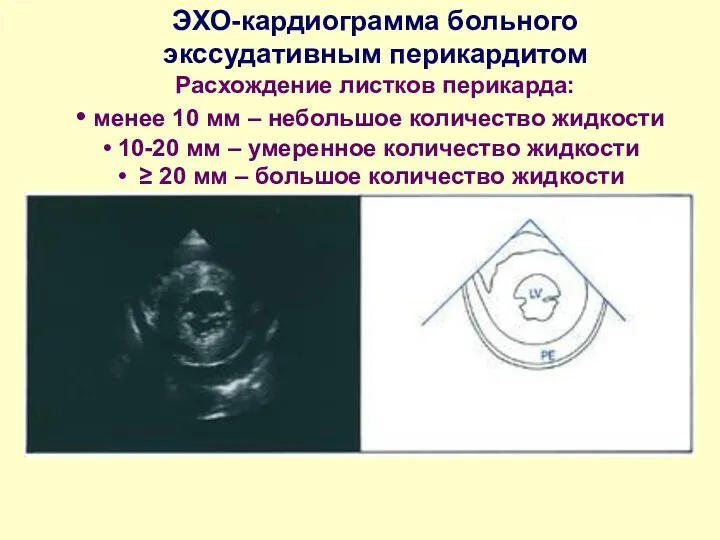 ЭХО-кардиограмма больного экссудативным перикардитом Расхождение листков перикарда: менее 10 мм