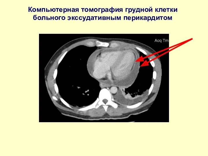 Компьютерная томография грудной клетки больного экссудативным перикардитом