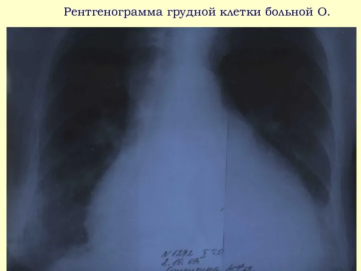 Pентгенограмма грудной клетки больной O.
