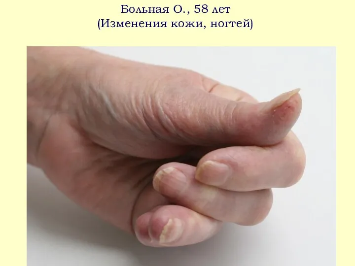 Больная О., 58 лет (Изменения кожи, ногтей)
