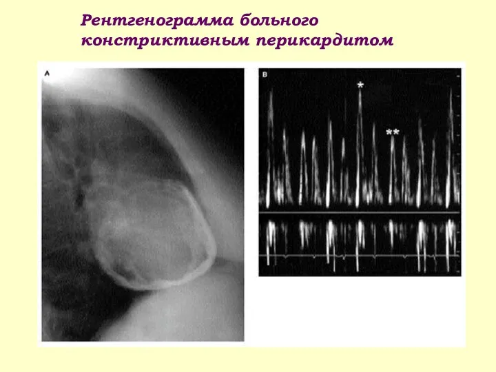Рентгенограмма больного констриктивным перикардитом
