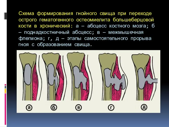 Схема формирования гнойного свища при переходе острого гематогенного остеомиелита большеберцовой