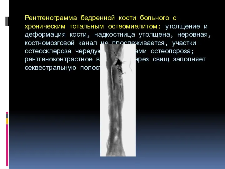 Рентгенограмма бедренной кости больного с хроническим тотальным остеомиелитом: утолщение и