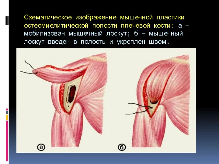 Схематическое изображение мышечной пластики остеомиелитической полости плечевой кости: а —