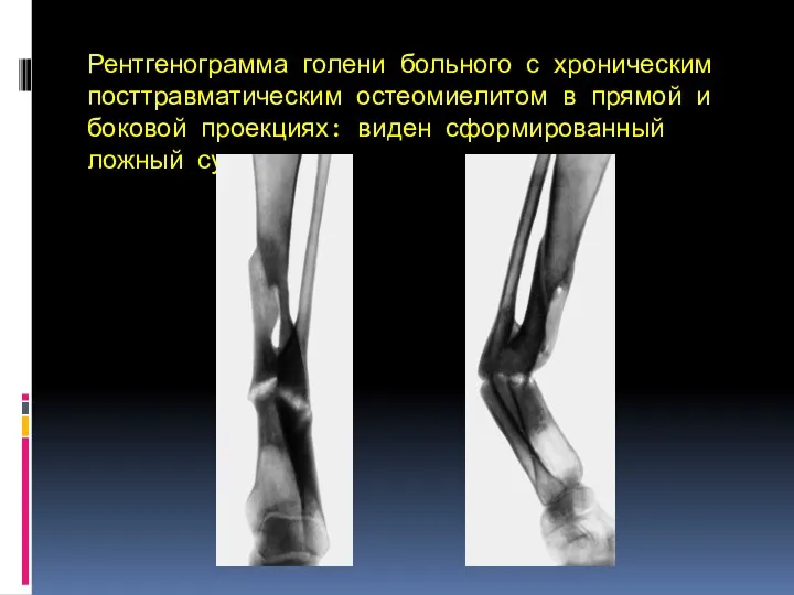 Рентгенограмма голени больного с хроническим посттравматическим остеомиелитом в прямой и боковой проекциях: виден сформированный ложный сустав.