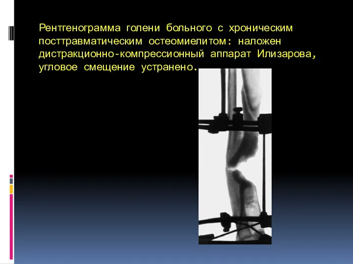 Рентгенограмма голени больного с хроническим посттравматическим остеомиелитом: наложен дистракционно-компрессионный аппарат Илизарова, угловое смещение устранено.