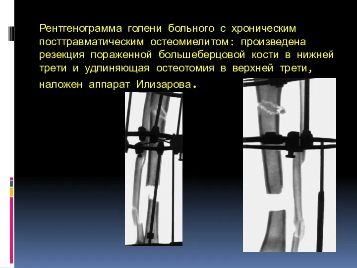 Рентгенограмма голени больного с хроническим посттравматическим остеомиелитом: произведена резекция пораженной