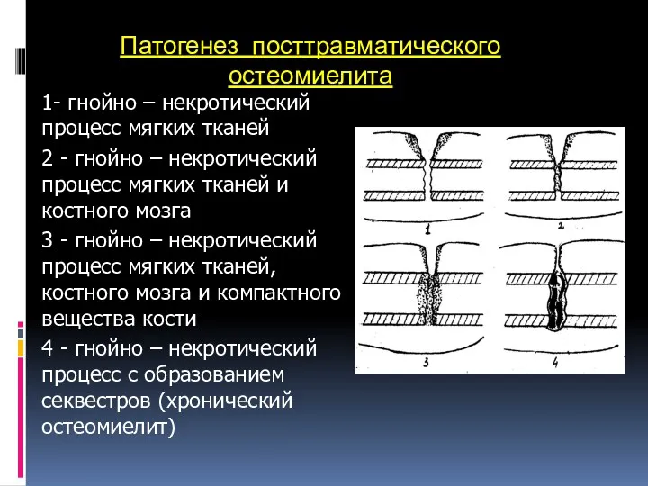 Патогенез посттравматического остеомиелита