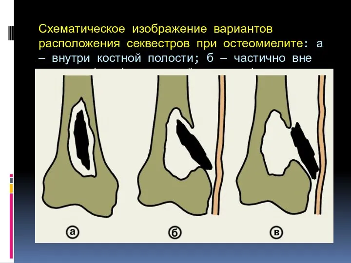 Схематическое изображение вариантов расположения секвестров при остеомиелите: а — внутри