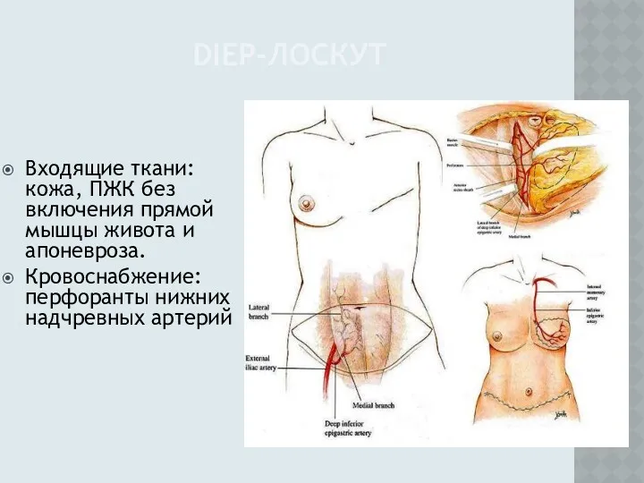 DIEP-ЛОСКУТ Входящие ткани: кожа, ПЖК без включения прямой мышцы живота