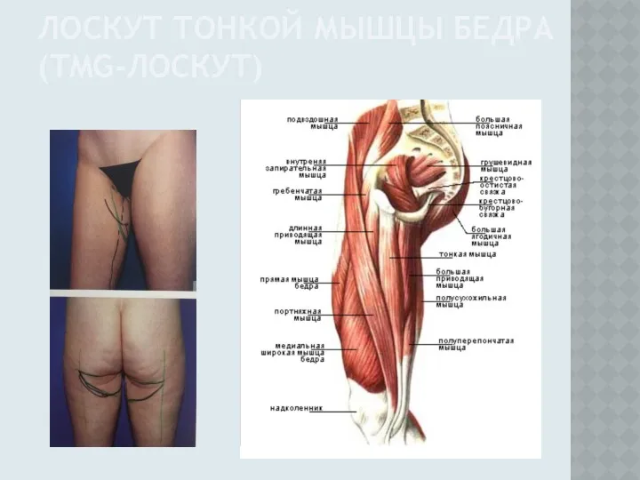 ЛОСКУТ ТОНКОЙ МЫШЦЫ БЕДРА (TMG-ЛОСКУТ)