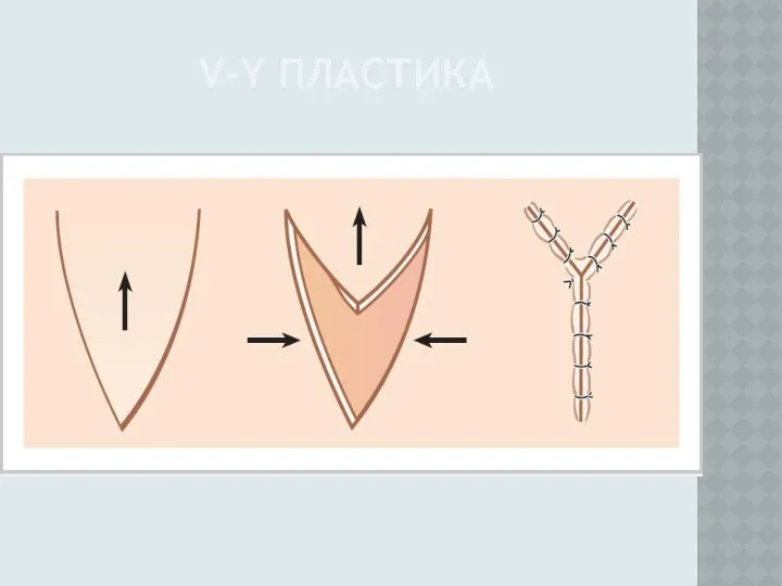 V-Y ПЛАСТИКА