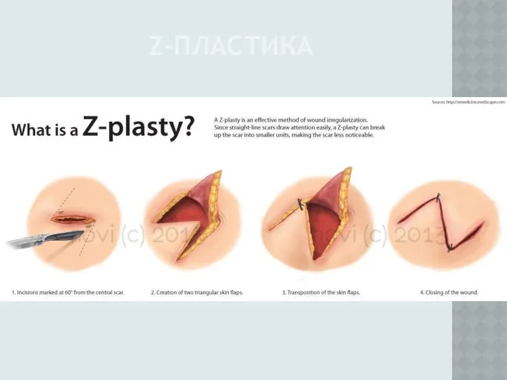 Z-ПЛАСТИКА