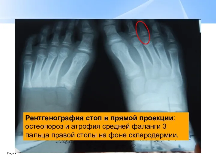 Рентгенография стоп в прямой проекции: остеопороз и атрофия средней фаланги 3 пальца правой