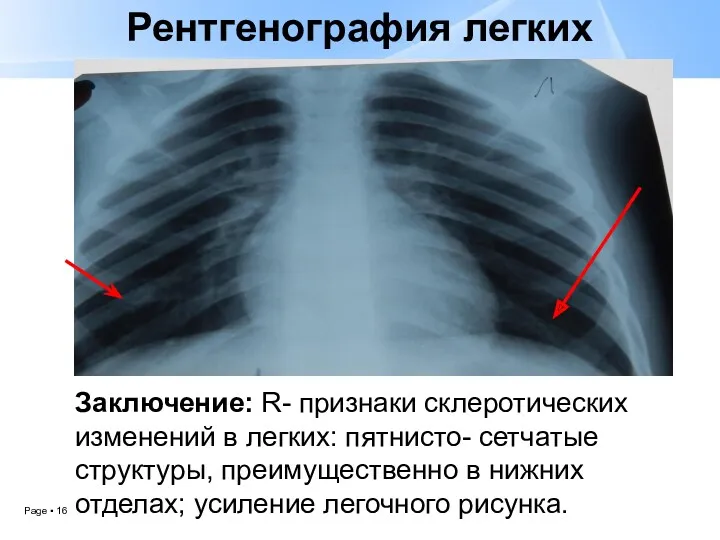 Рентгенография легких Заключение: R- признаки склеротических изменений в легких: пятнисто- сетчатые структуры, преимущественно