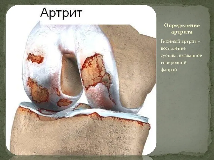 Гнойный артрит – воспаление сустава, вызванное гноеродной флорой Определение артрита