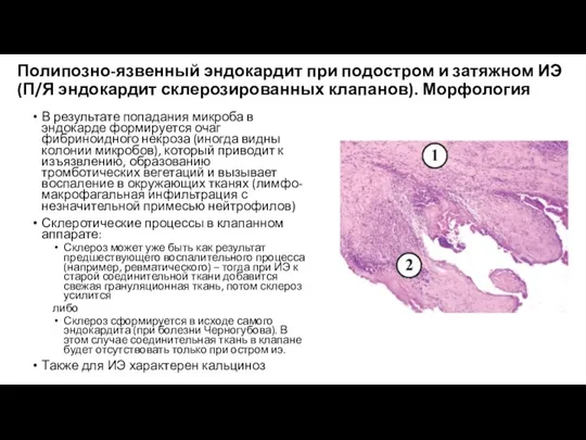 Полипозно-язвенный эндокардит при подостром и затяжном ИЭ (П/Я эндокардит склерозированных