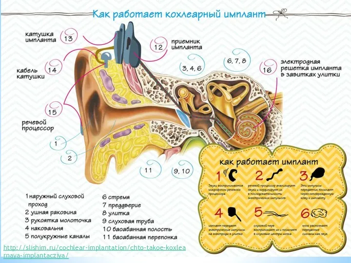 http://slishim.ru/cochlear-implantation/chto-takoe-koxlearnaya-implantacziya/