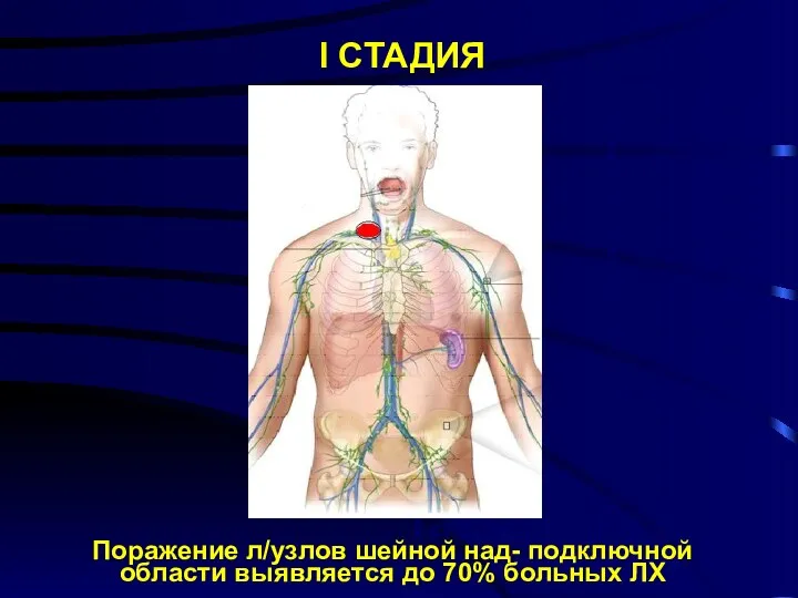 С у б тотальное I СТАДИЯ I стадия Поражение л/узлов