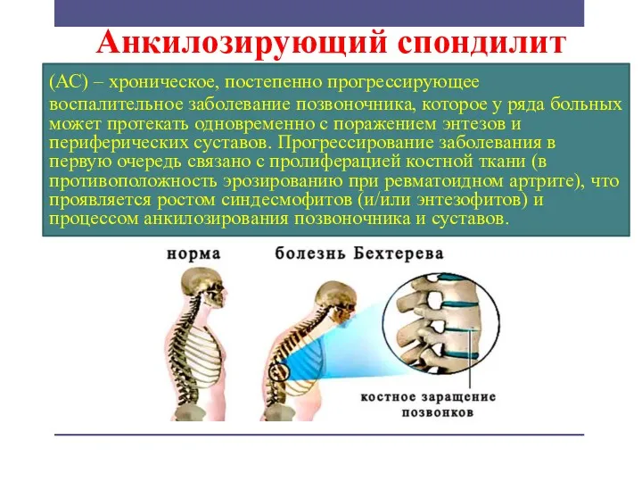 Анкилозирующий спондилит (АС) – хроническое, постепенно прогрессирующее воспалительное заболевание позвоночника,