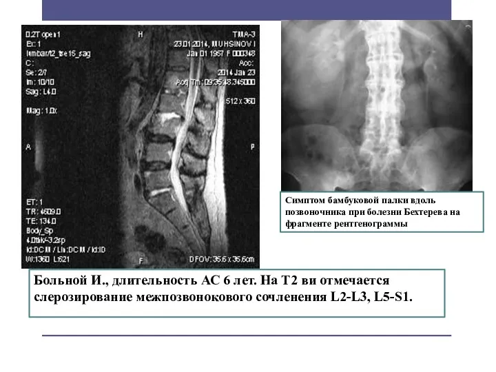 Симптом бамбуковой палки вдоль позвоночника при болезни Бехтерева на фрагменте