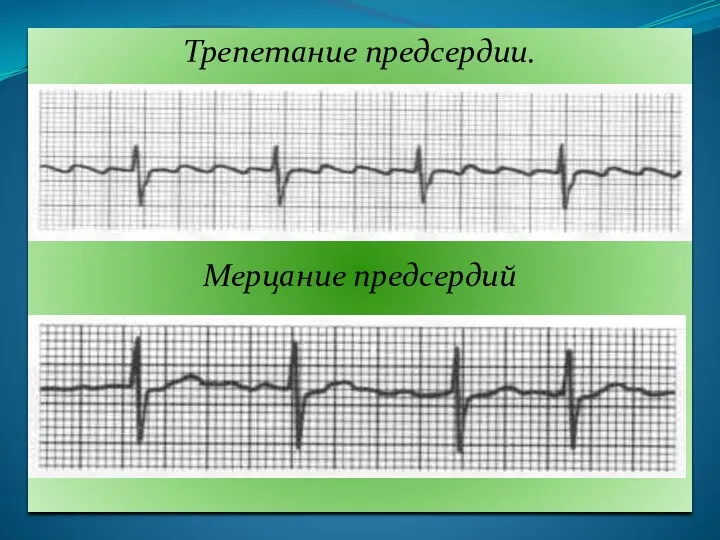 Трепетание предсердии. Мерцание предсердий