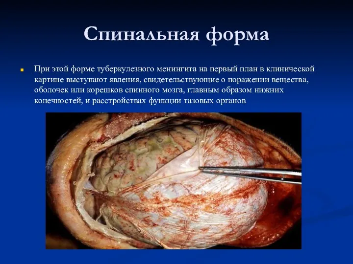 Спинальная форма При этой форме туберкулезного менингита на первый план