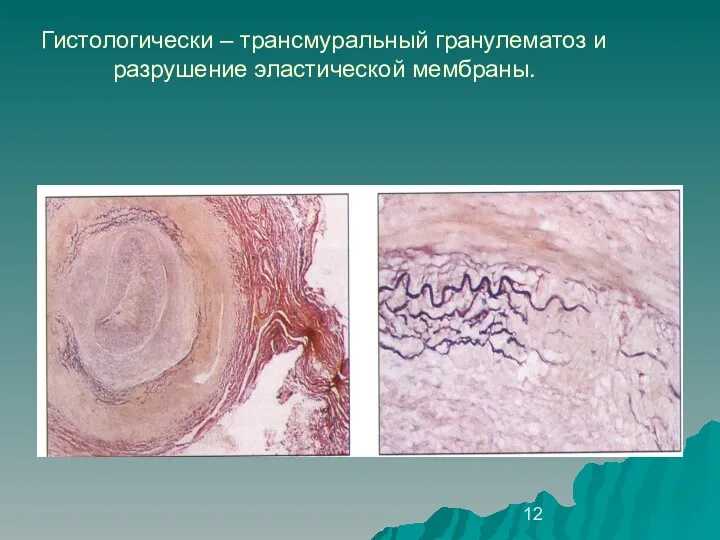 Гистологически – трансмуральный гранулематоз и разрушение эластической мембраны.