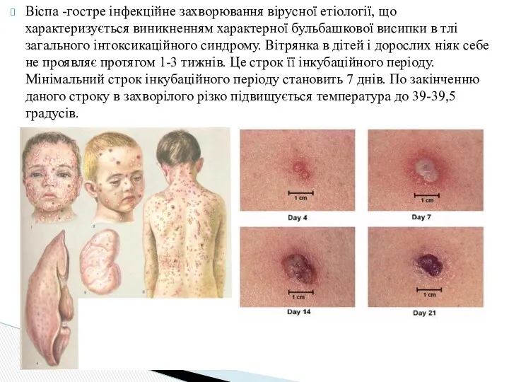Віспа -гостре інфекційне захворювання вірусної етіології, що характеризується виникненням характерної бульбашкової висипки в