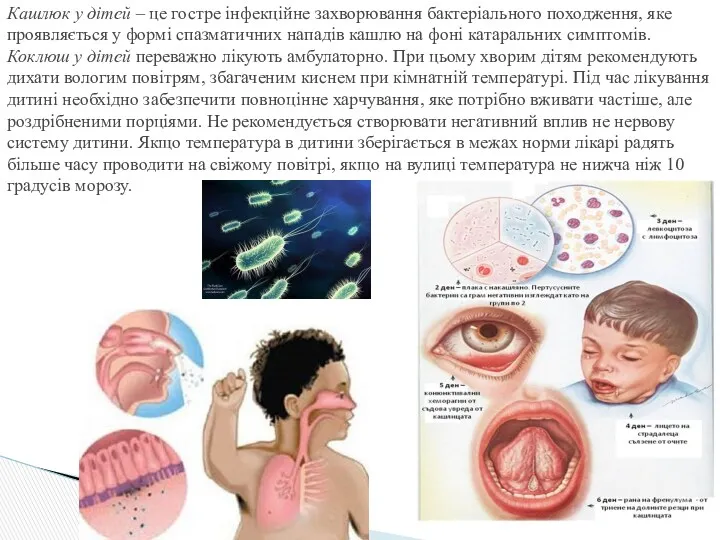 Кашлюк у дітей – це гостре інфекційне захворювання бактеріального походження, яке проявляється у