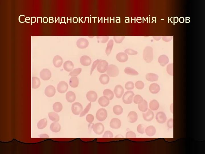 Серповидноклітинна анемія - кров