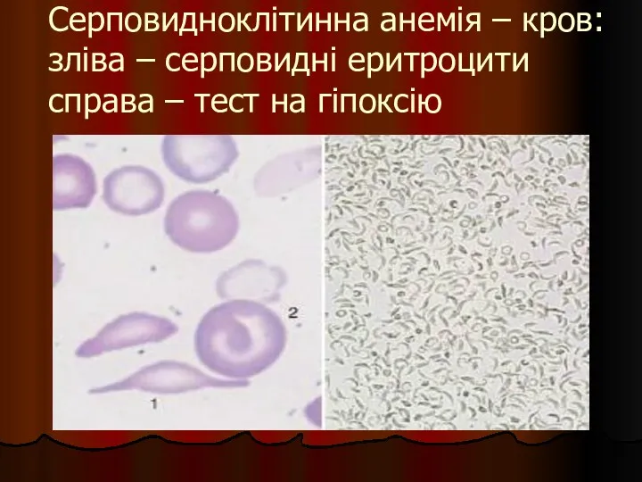 Серповидноклітинна анемія – кров: зліва – серповидні еритроцити справа – тест на гіпоксію