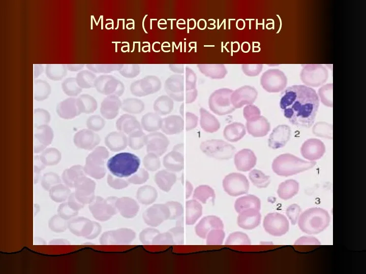 Мала (гетерозиготна) таласемія – кров