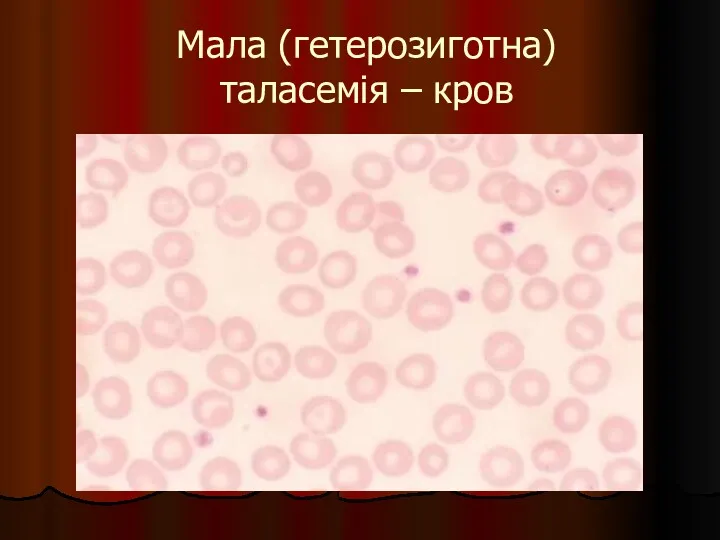 Мала (гетерозиготна) таласемія – кров