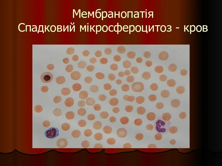 Мембранопатія Спадковий мікросфероцитоз - кров