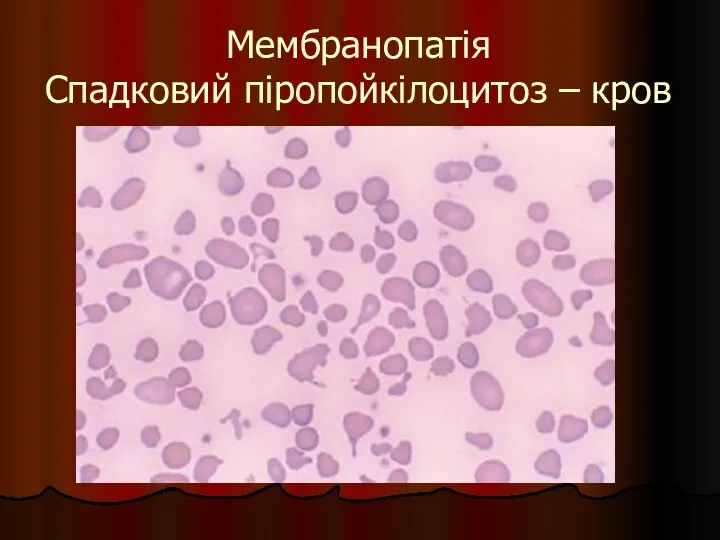 Мембранопатія Спадковий піропойкілоцитоз – кров