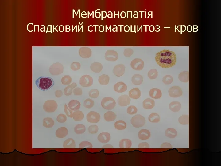 Мембранопатія Спадковий стоматоцитоз – кров
