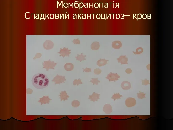 Мембранопатія Спадковий акантоцитоз– кров