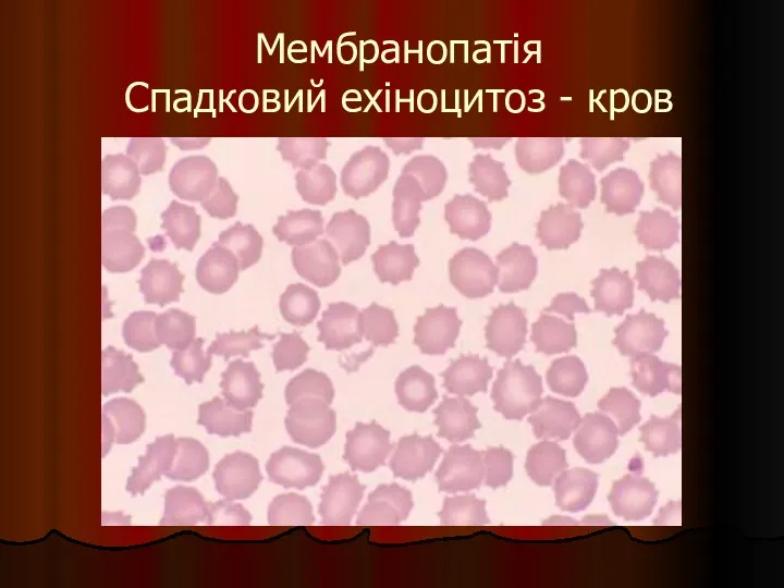 Мембранопатія Спадковий ехіноцитоз - кров