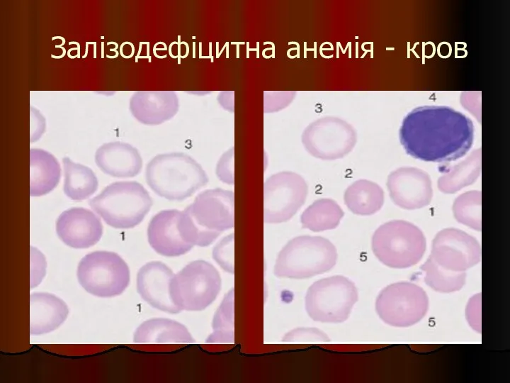 Залізодефіцитна анемія - кров