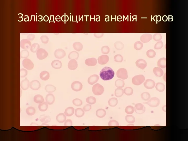 Залізодефіцитна анемія – кров