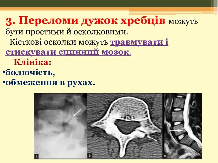 3. Переломи дужок хребців можуть бути простими й осколковими. Кісткові