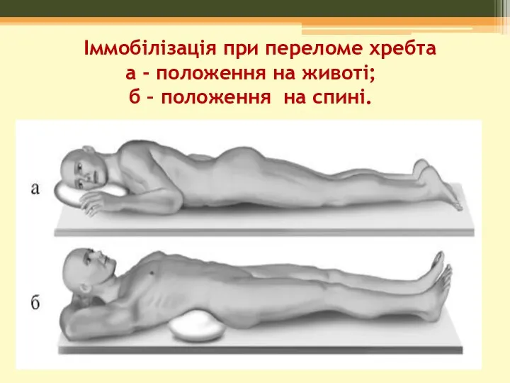 Іммобілізація при переломе хребта а - положення на животі; б – положення на спині.