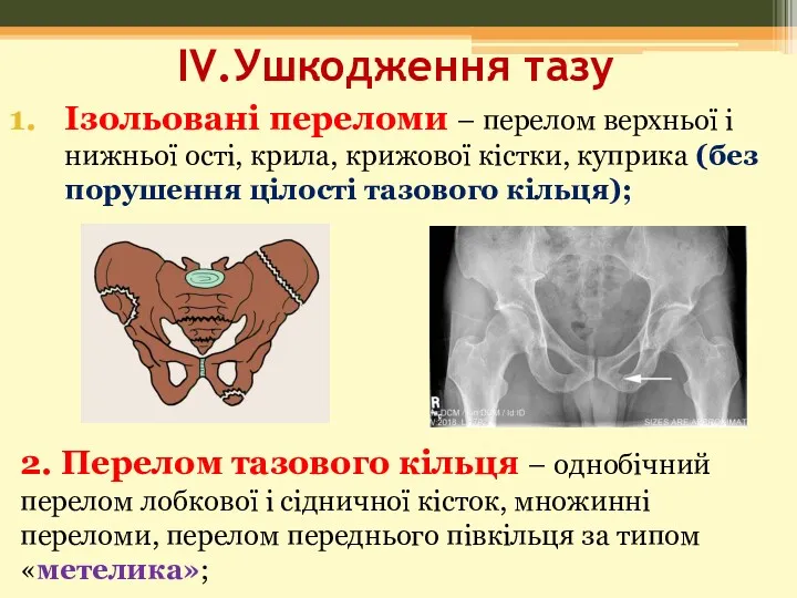 IV.Ушкодження тазу Ізольовані переломи – перелом верхньої і нижньої ості, крила, крижової кістки,
