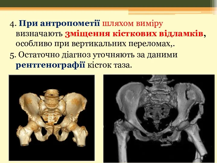 4. При антропометії шляхом виміру визначають 3міщення кісткових відламків, особливо