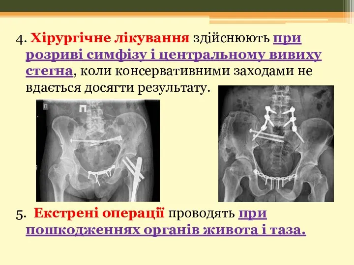 4. Хірургічне лікування здійснюють при розриві симфізу і центральному вивиху