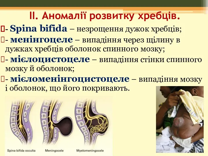 II. Аномалії розвитку хребців. - Spina bifida – незрощення дужок хребців; - менінгоцеле