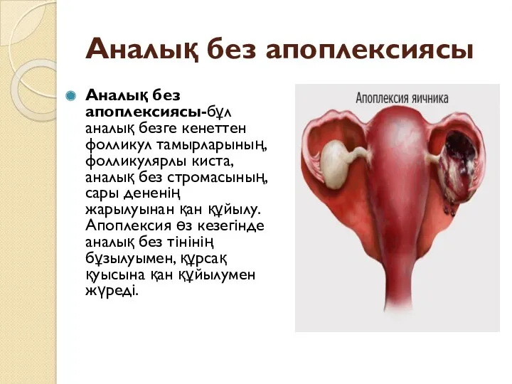 Аналық без апоплексиясы Аналық без апоплексиясы-бұл аналық безге кенеттен фолликул