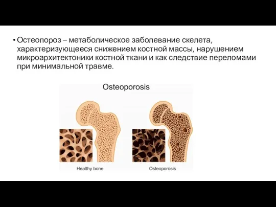 Остеопороз – метаболическое заболевание скелета, характеризующееся снижением костной массы, нарушением