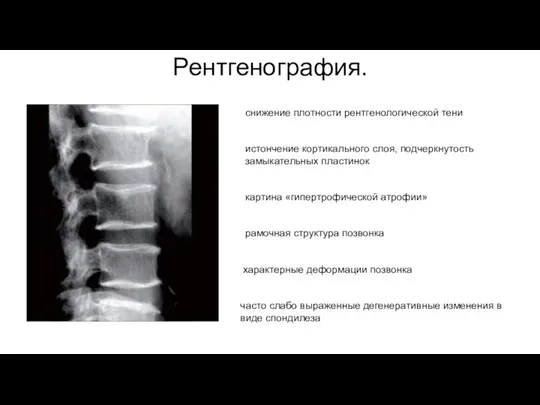 Рентгенография. снижение плотности рентгенологической тени истончение кортикального слоя, подчеркнутость замыкательных